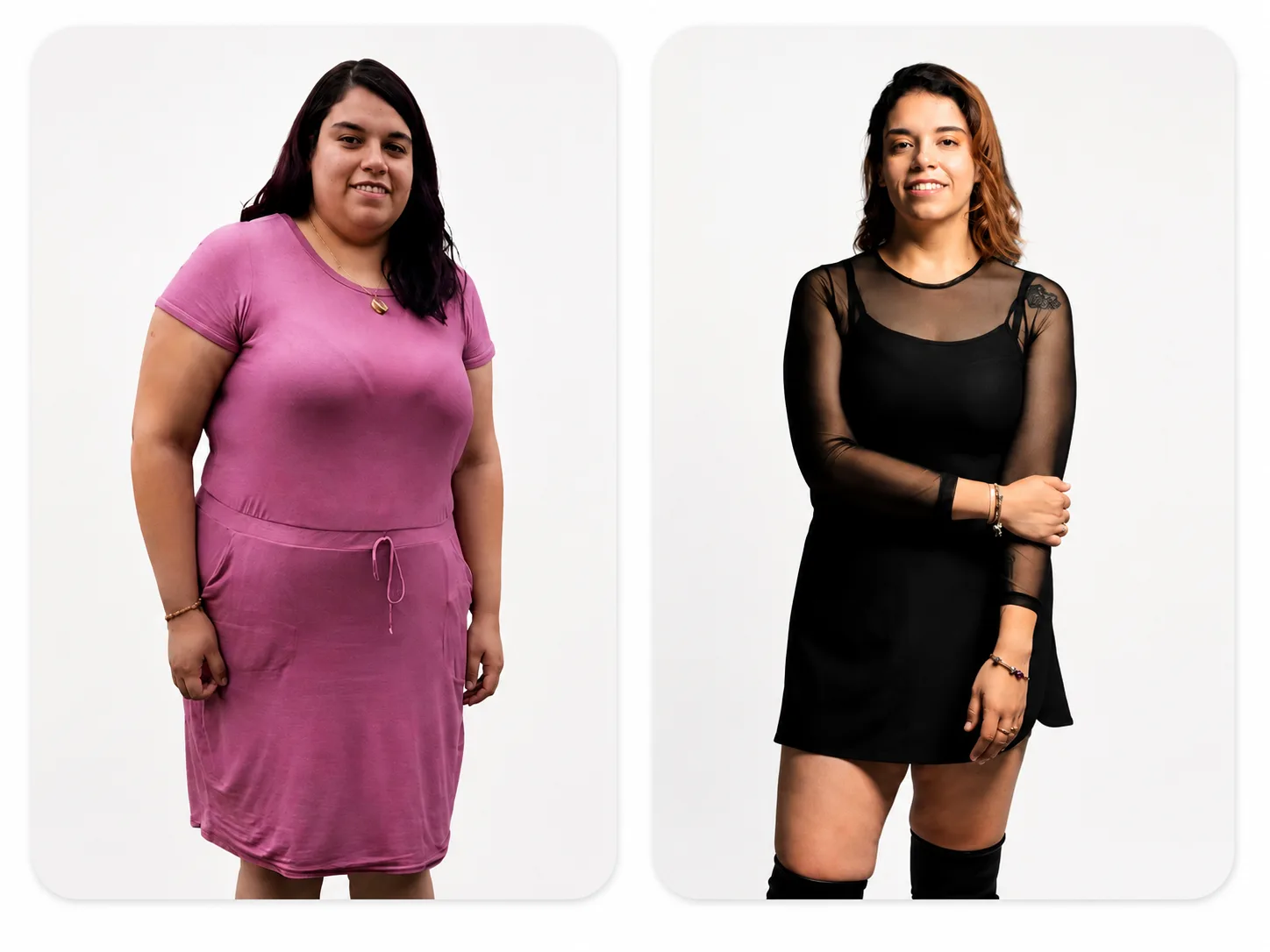 Antes y después — balón gástrico