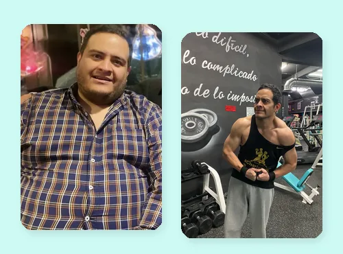 Antes y después — bypass gástrico